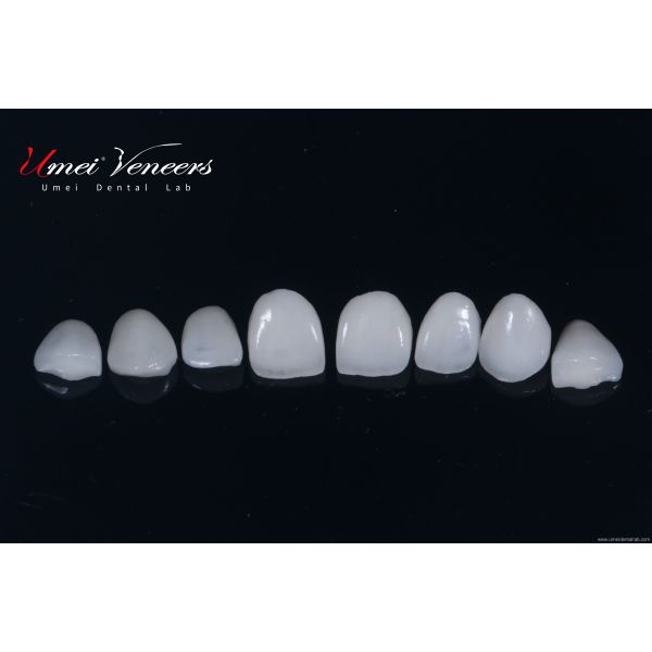 Natural clear zirconia veneers