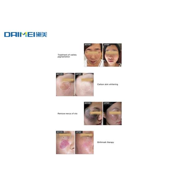 Salon Use Q Switched Nd Yag Laser Machine For Pigmentation / Tattoo Removal