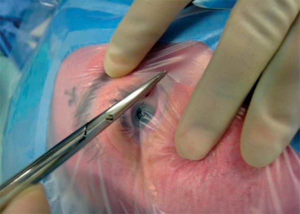Eye / Ophthalmic Disposable Sterile Surgical Drapes With Incision Film With Liquid Collection Pouch