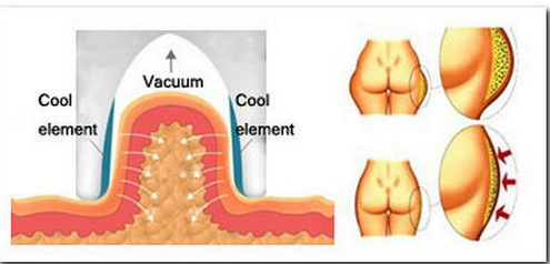 Fat Freezing body slimming Cryolipolysis Vacuum LED lose weight Machine