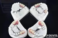 Establecer un marco tecnológico para el acabado de los dientes para una estructura oral estable