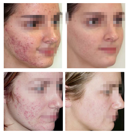 Частичный лазер СО2 применяет обложку к удалению шрама угорь удаления морщинки подмолаживания для красоты