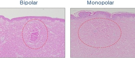 Fractional RF Microneedle For Wrinkle Removal / Skin Tightening