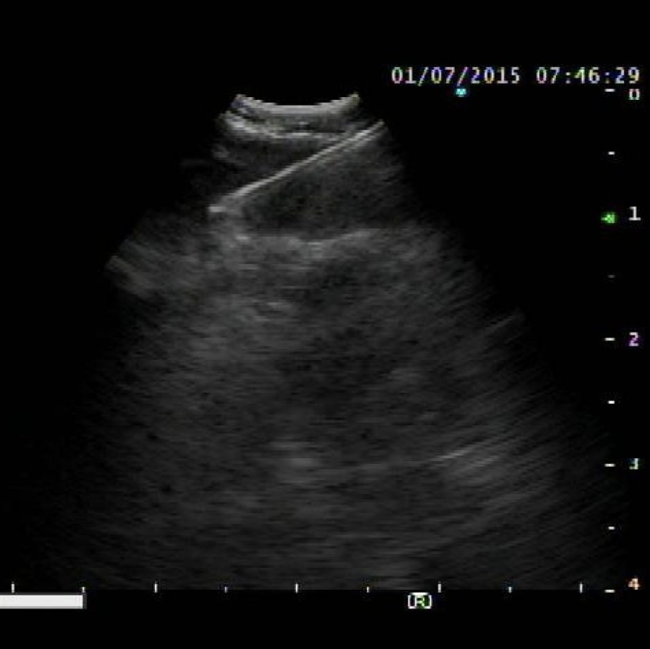 ExpectTM Ecografía pulmonar-endobronquial Aguja de aspiración transbronquial