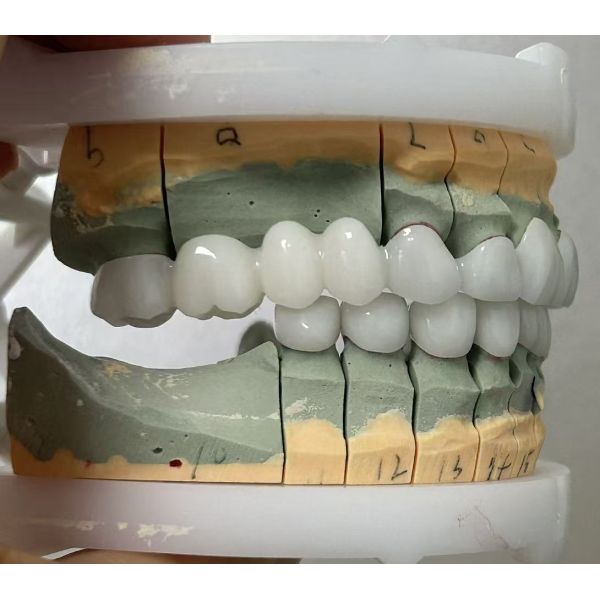 Full Zirconia dental bridge for high strength and durable dental restoration