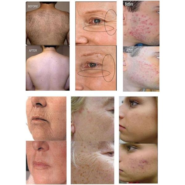 SHR IPL Elight hair removal machine with great after sale services