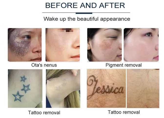Beijing medical beauty nd yag laser Tattoo removal of eyeline removal machine