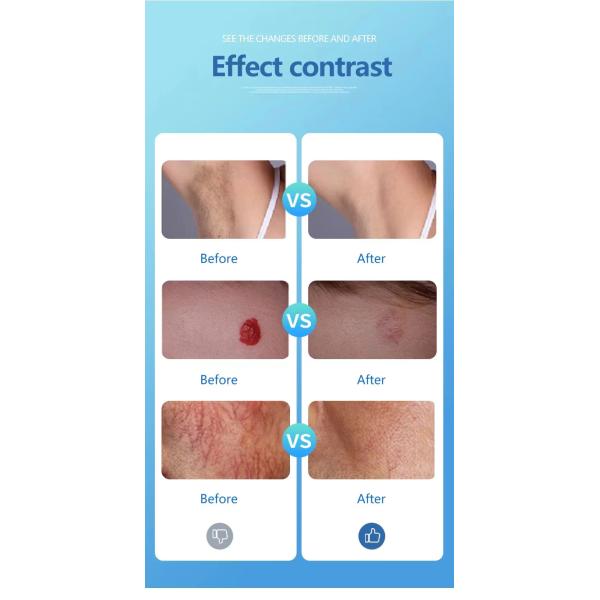LZR P6 Picosecond Laser Machine 810 Skin Rejuvenation Machine With 2-10 Mm Spot Size