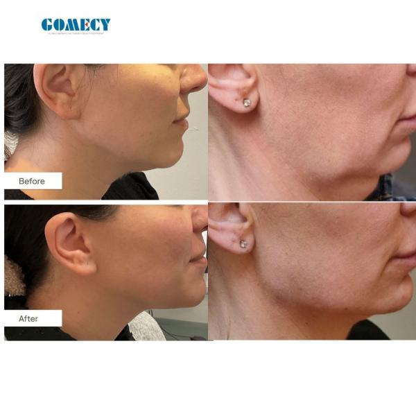 1470nm 980nm 6 + 1 Diode Laser Therapy Device Fiber-Coupled Laser For Vascular Removal