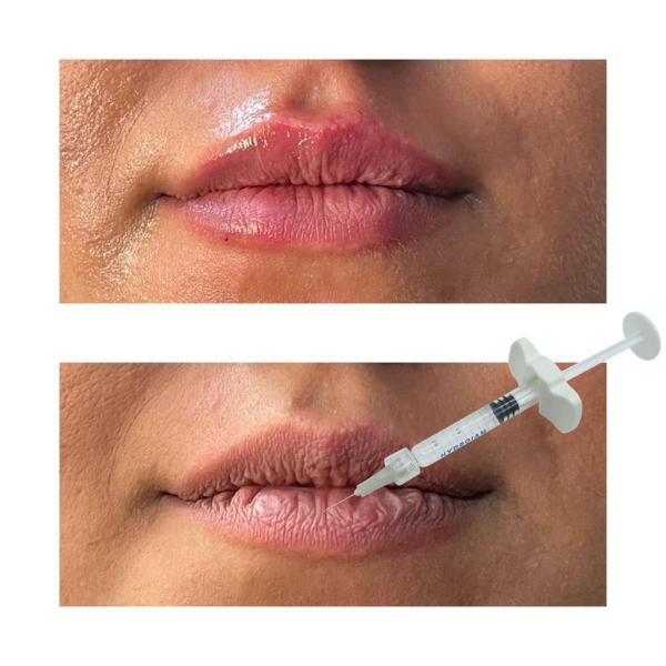 Dermal Lip Fillers Safe Effective For Medical Professionals