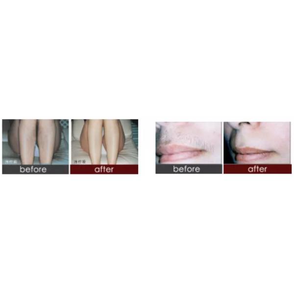 Depilation Diode Laser Hair Removal Machine 3 Wavelength 755nm 808nm 1064nm