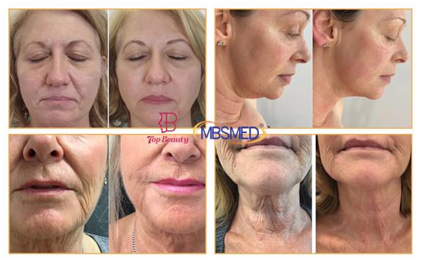7D 12D 14D ICE HIFU Face Lifting Wrinkle Removal HIFU Machine