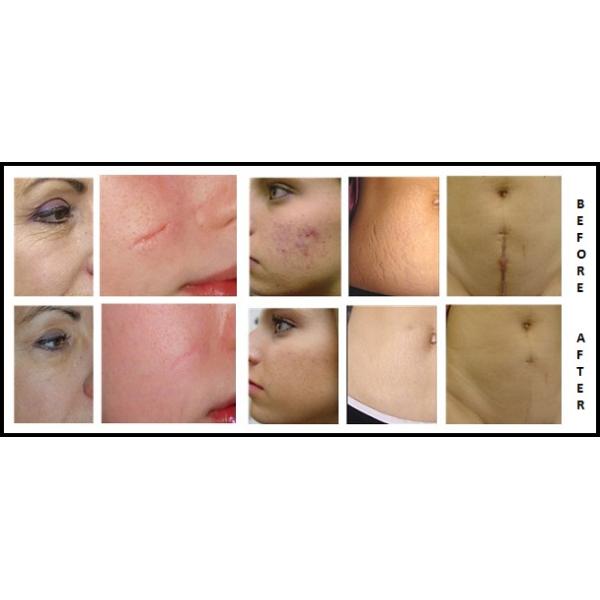 vaginal Co2 Fractional Laser Machine for vaginal tighten and skin rejuvenation