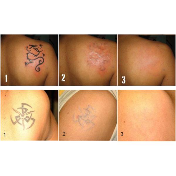 Portable 532nm 1320nm 1064nm Q cambió la eliminación de tatuajes de la máquina láser Nd Yag