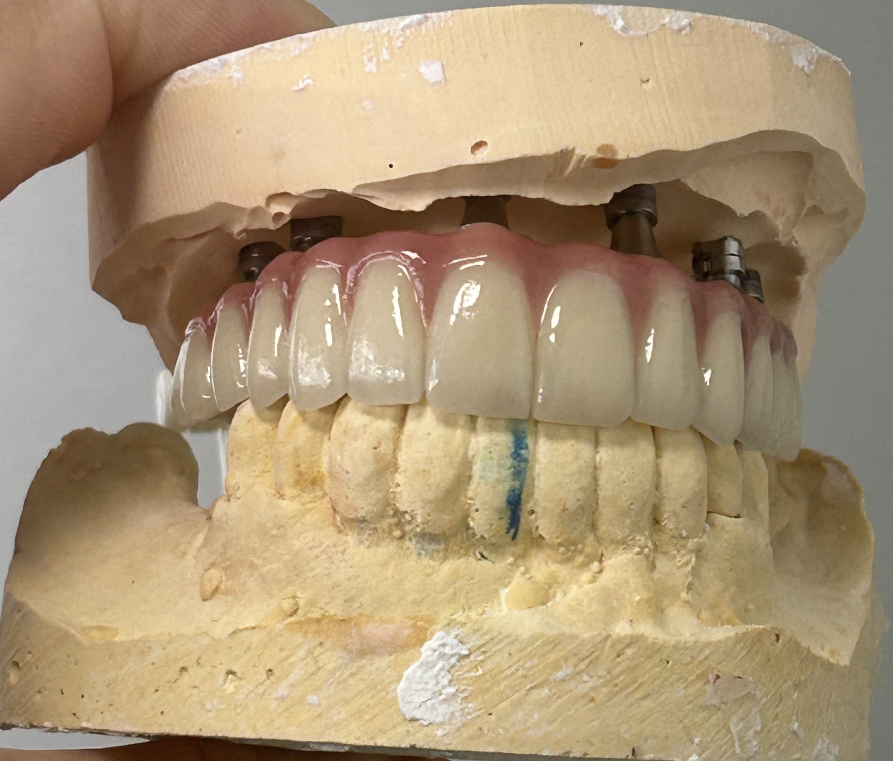 High-Strength Dental Zirconia Implant Crown with Natural Translucency & Tooth-Like Appearance via Digital CAD/CAM