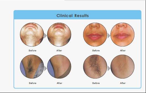 Постоянная машина удаления волос SHR выбирает метод Ipl для спы красотки