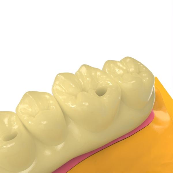 Résine photosensible pour pont dentaire