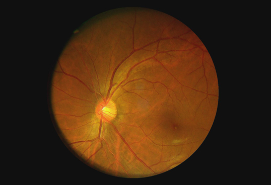Handheld портативная офтальмическая камера Fundus цифров системы с высокой телемедициной объектива определения 1080P доступной