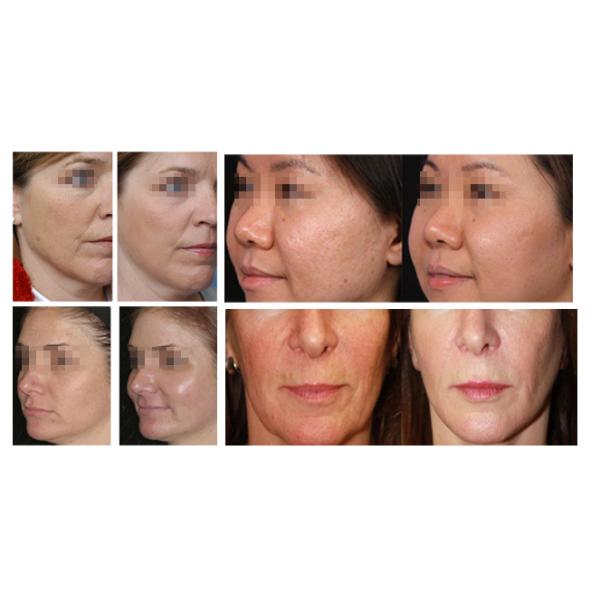 Anti - Aging Portable Hydrafacial Machine , Wrinkle Removal Hydra Beauty Machine