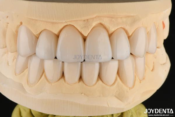 0.3-0.5mm Thick Feldspathic Porcelain Veneer High Fracture Resistance Upgrade Your Smile