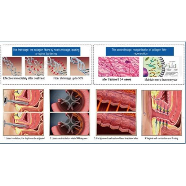 Машины лазера СО2 эрбия дерматологии машина лазера подмолаживания кожи частичной влагалищная