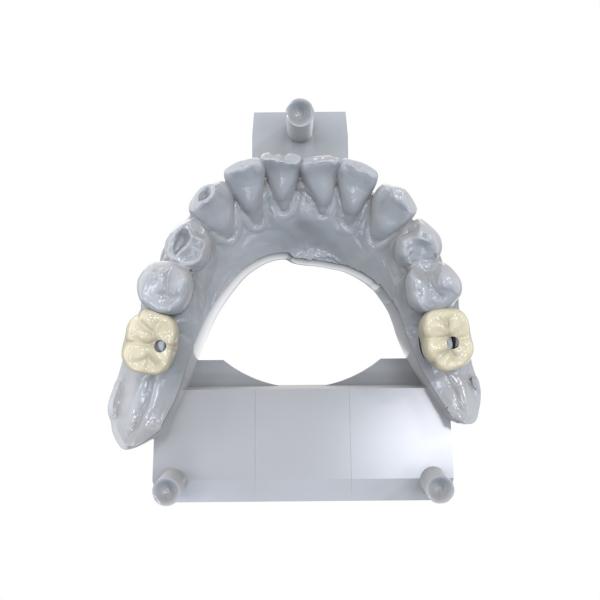 Long-Lasting Low Water Absorption Permanent Crown Resin for Porcelain-Filled Metal PFM Crowns