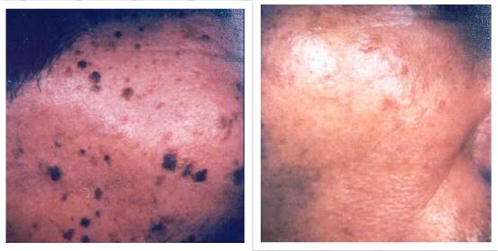 FDA and Medical CE approved Q Switched Nd yag laser for tattoo removal,birthmark.pigmentation removal dermatologist
