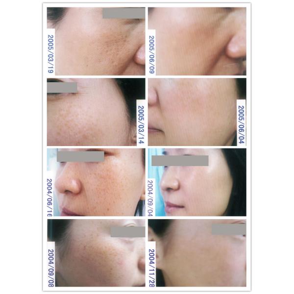 Máquina del retiro del pelo de SHR IPL, equipo 1064nm/532nm del rejuvenecimiento de la piel