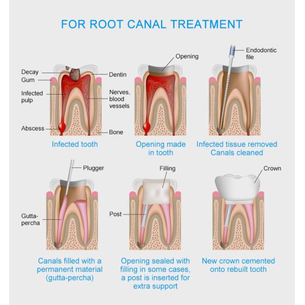 Endodontic Dental Absorbent Paper Points Dental Gutta Percha Points Composite Filling