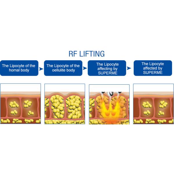 ODM лазера Nd Yag Rf выбирает удаление волос машины Shr Ipl профессиональное безболезненное