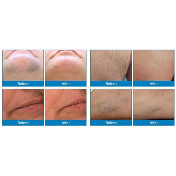 Professional Freckle Removal IPL Laser Hair Removal Machine Stable Performance