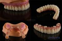 Dental Multiple Teeth Replacement Implants Rough Surface Prosthetic Components