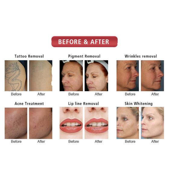 640nm 530nm 480nm IPL Laser Hair Removal Machine SHR OPT Elight Machine