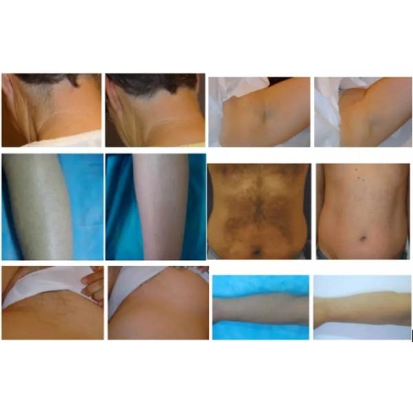 Full Body 850nm 808 Laser Hair Removal Device 10 Bars Germany
