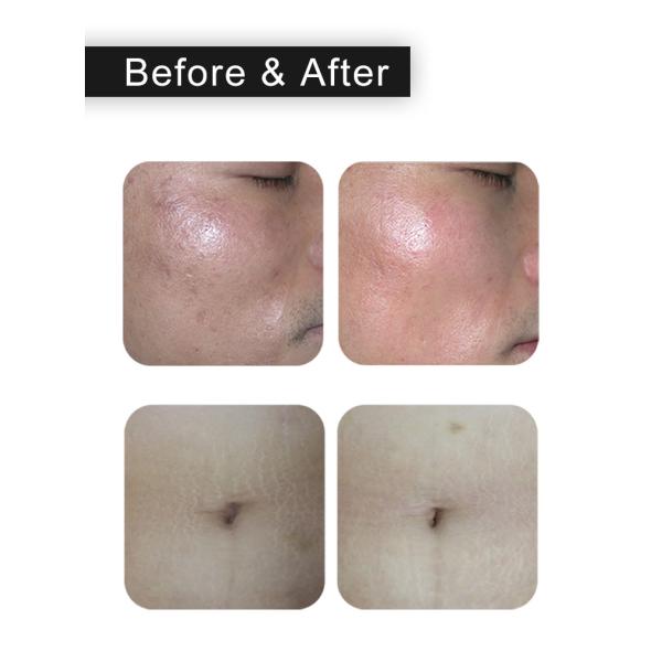 Ультра пульсирует СО2 RF затягивая машину 10.57um-10.63um