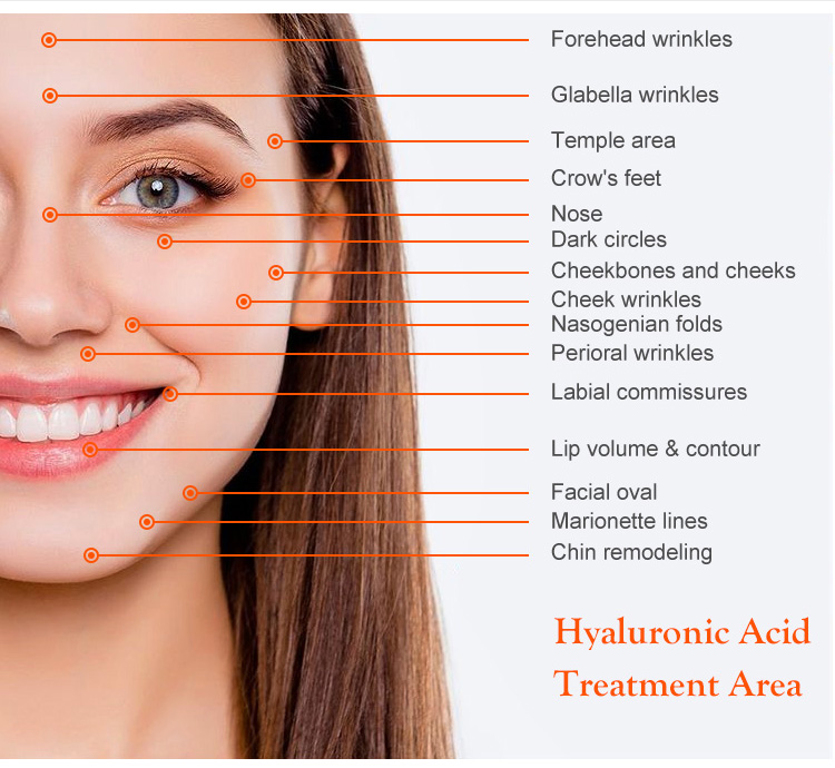 Впрыска 3ml 5ml 10ml заполнителя Revolax Hyaluronic кисловочная дермальная