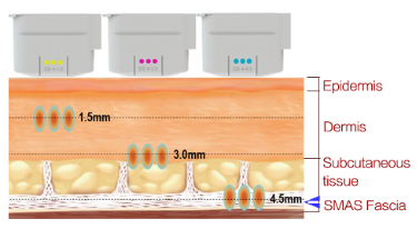 Высокая интенсивность сфокусировала уменьшение морщинки машины красоты ультразвука анти-
