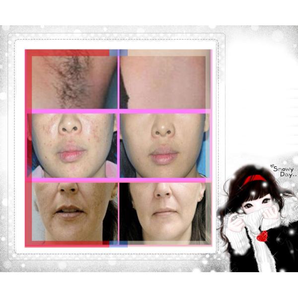 Vertical E- Light Hair Removal Machine , Armpit SHR Hair Removal Machine