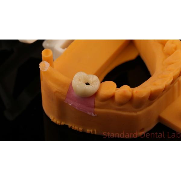 Dental Implant Screw Retained Crown PFZ Porcelain Layered Zirconia With 3D Print Model