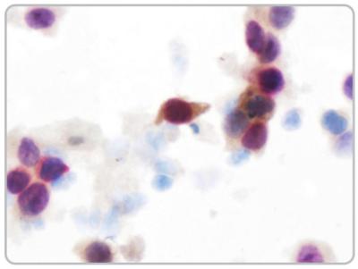 Cervical Cancer Screening ICC Immunoassay Test Kit Cap Asccp p16 / Ki-67 CE