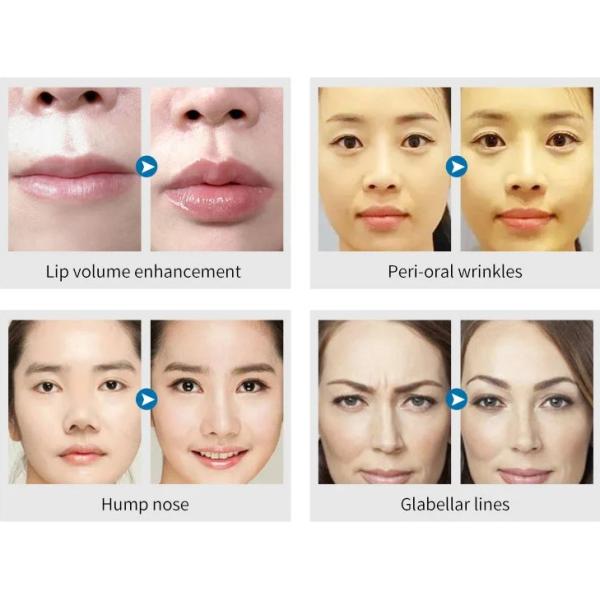 коррекция морщинки впрыски заполнителя глубокого натрия 2 ml Hyaluronic кисловочная дермальная
