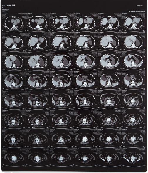 High-clarity Medical X Ray Film FUJI DIHT 14*17in Laser Dry Imaging Film