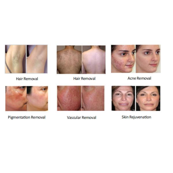 Medical CE Approved E-Light IPL RF Beauty Equipment For Wrinkle Removal