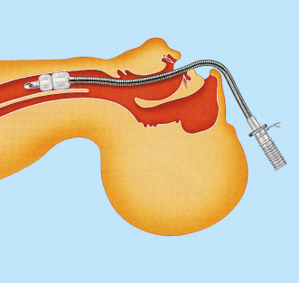 Трубка лазера медицинской нержавеющей стали устойчивая эндотрахеальная для хирургий гортани лазера