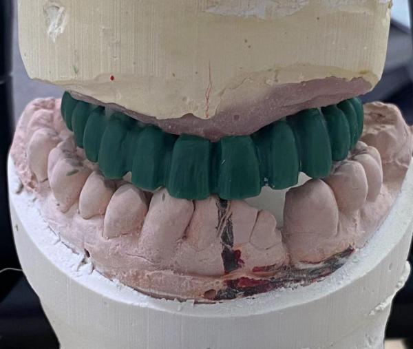 High Precision Implant Supported Crown Stable And Easy Maintenance