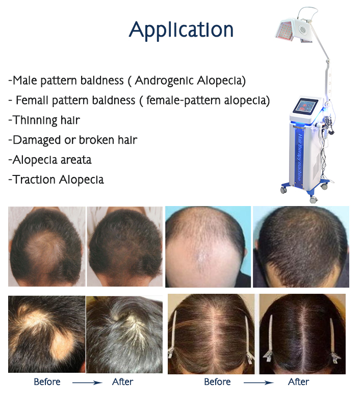 Professional Laser Beauty Machine with Multi Functional System for Hair Regrowth Scalp Hydration and Relief of Itching and Dandruff