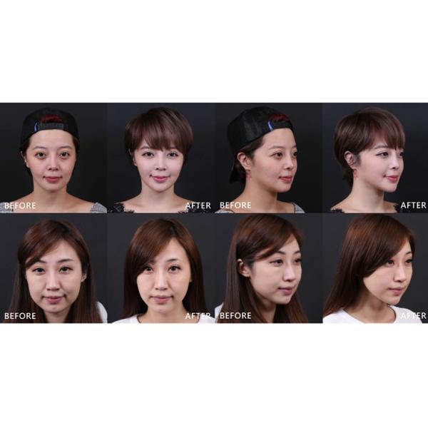 High Performance Hifu Equipment Weight Loss / Wrinkle Removal Facial Skin Hifu Ultrasonic