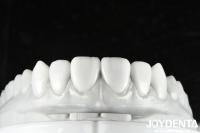 La cire dentaire de couleur naturelle est une solution polyvalente pour la restauration d'une ou plusieurs dents.