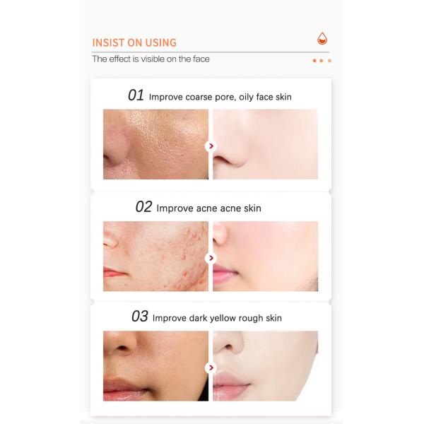 Тонер для кожи маслообразного угорь прональной разводя лицевой туман водой стороны салициловой кислоты BHA тонера AHA