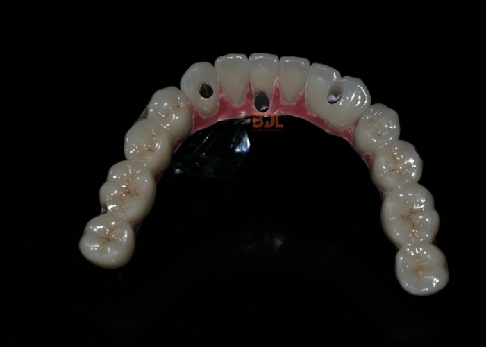 Durable Dental Implant Support Bar Featuring Superior Mechanical Properties for Effective Dental Prosthesis Integration